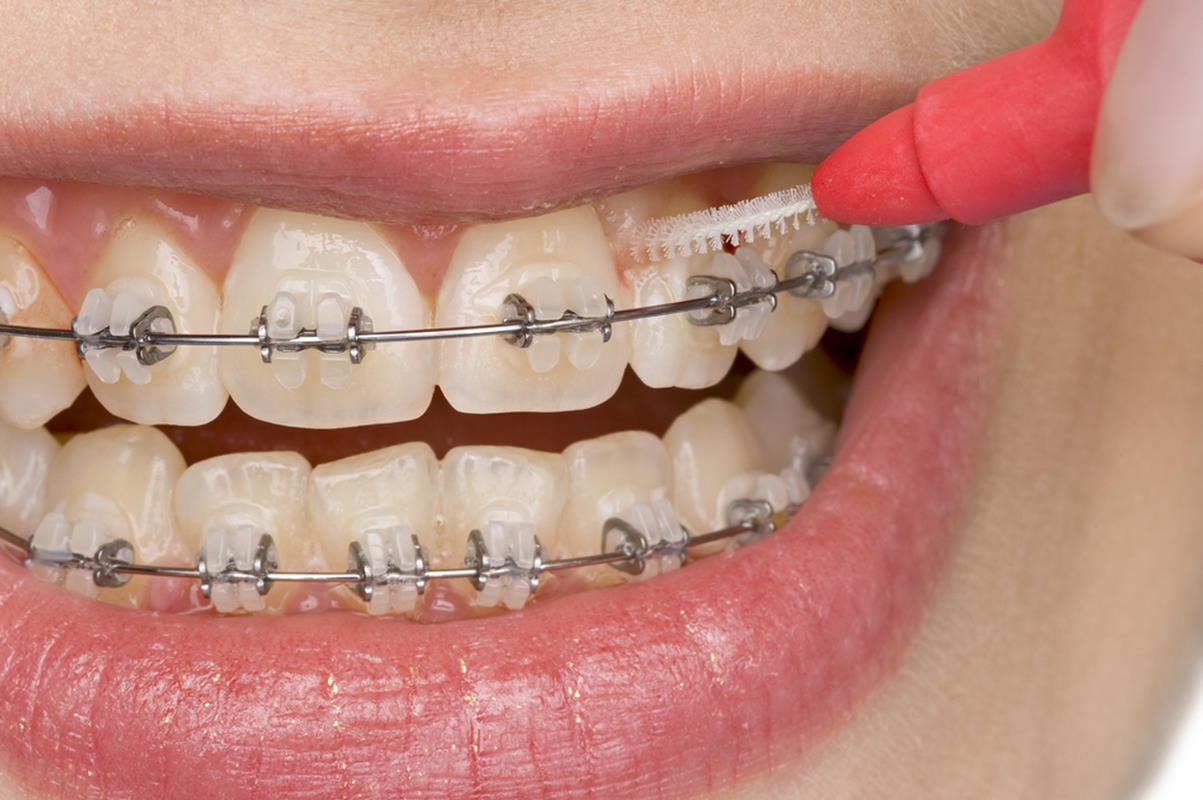 Types of Braces in Goddard, Hutchinson & Wichita | Hansen Orthodontics