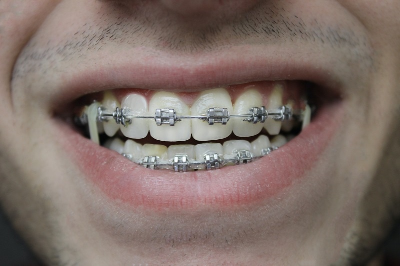 Wichita Dentist - Invisalign vs Traditional Braces