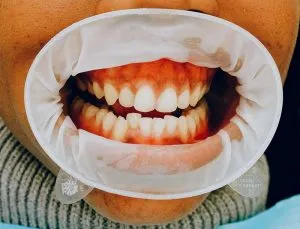 Crooked teeth and misaligned bite requiring orthodontic treatment at Hansen Orthodontics.